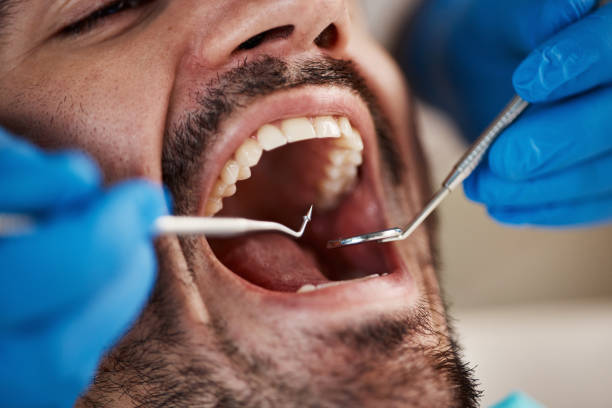 Best Emergency Dental Care for Broken or Chipped Teeth in New Holland, PA